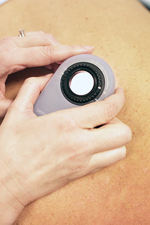 Doctor at Skin HQ using dermascope during a skin examination to check for signs of possible skin cancer